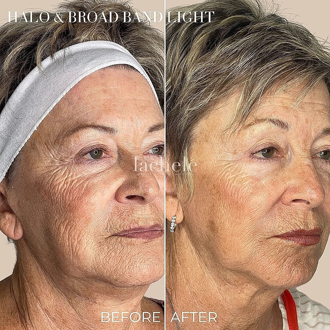 Skin treatment results: before and after comparison.