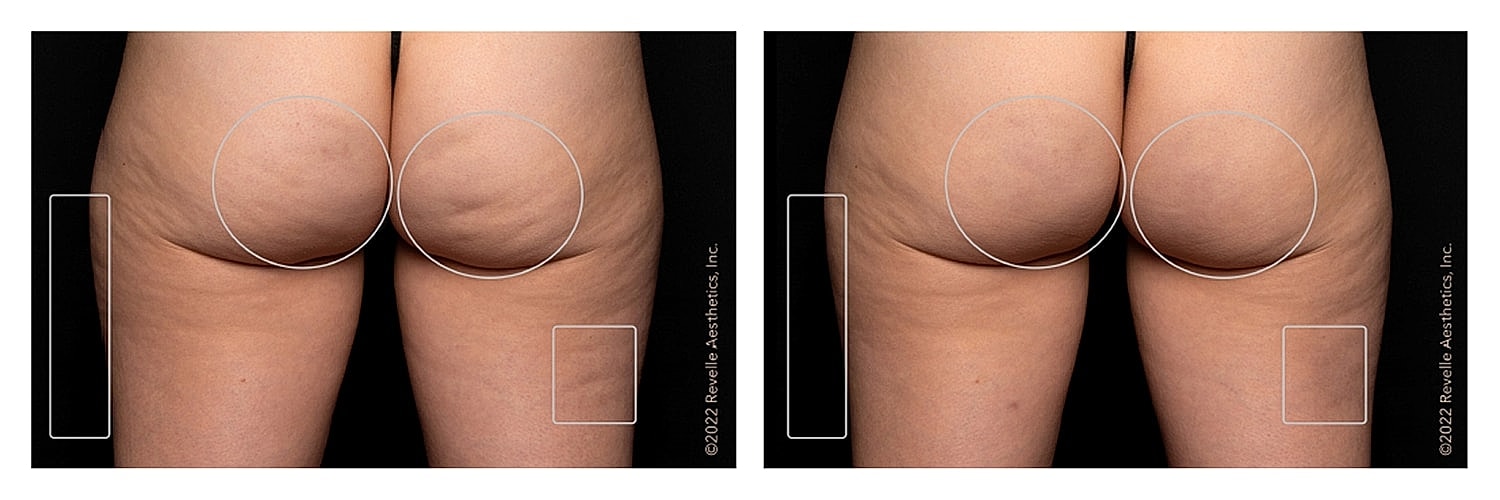 Before-and-after comparison of skin appearance.