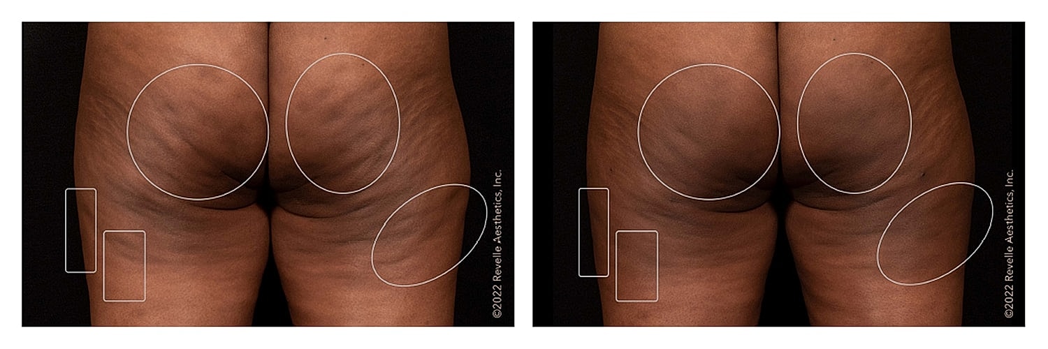 Before and after body contouring treatment comparison.