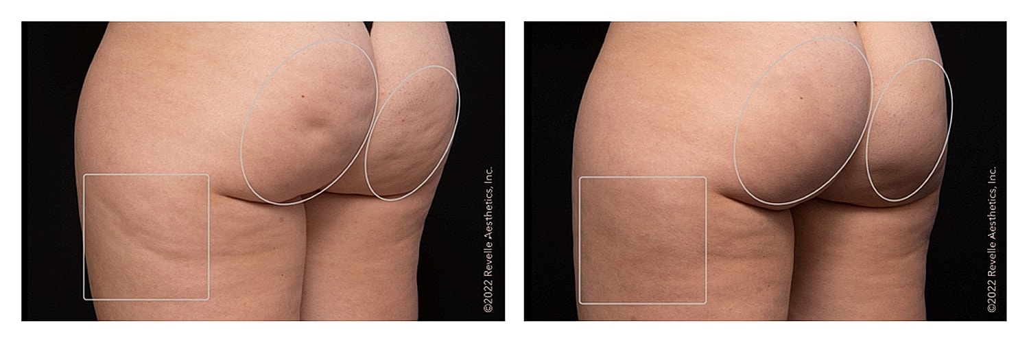 Before and after body contouring comparison.
