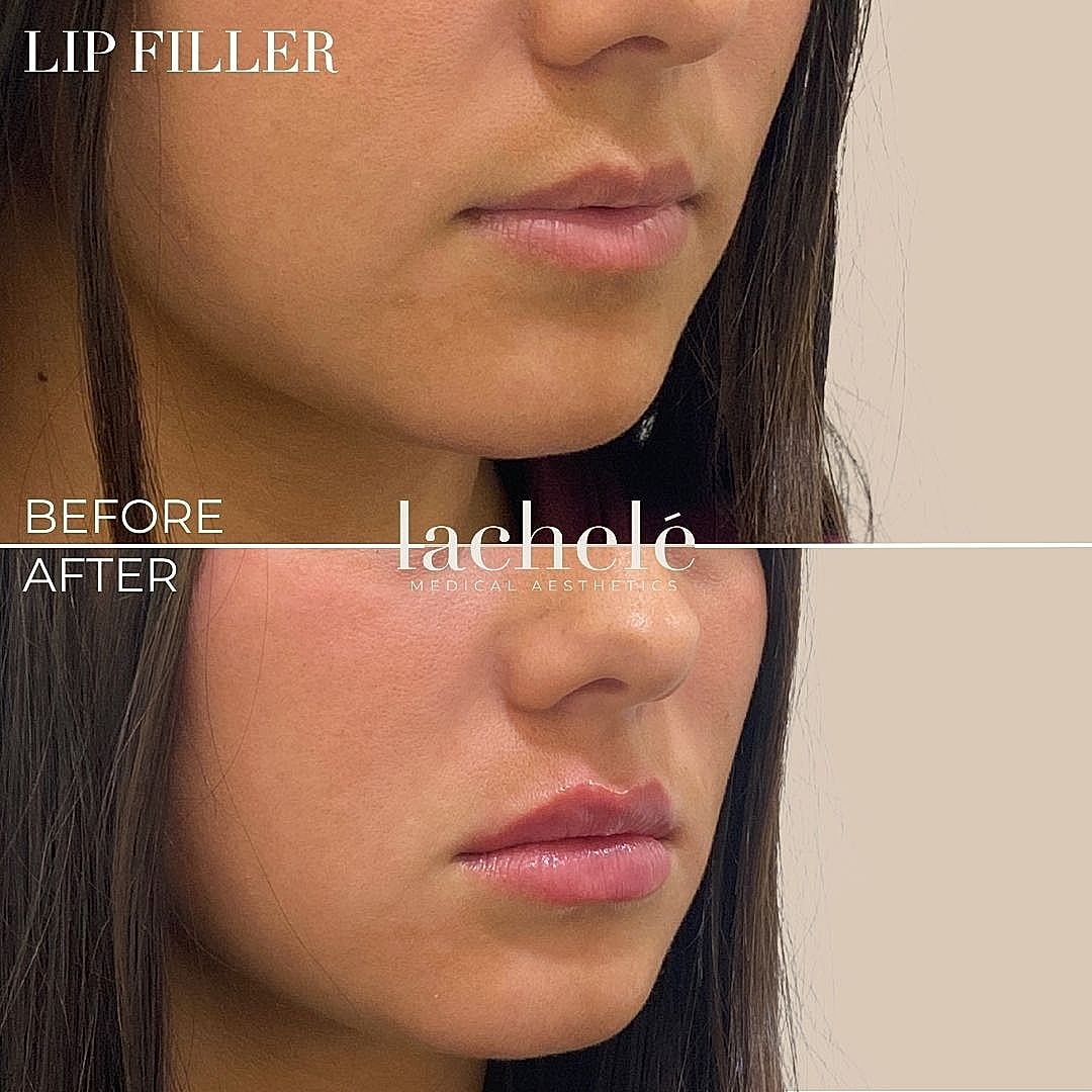 Lip filler before and after transformation.