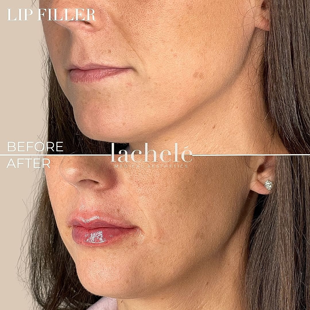 Before and after lip filler transformation.