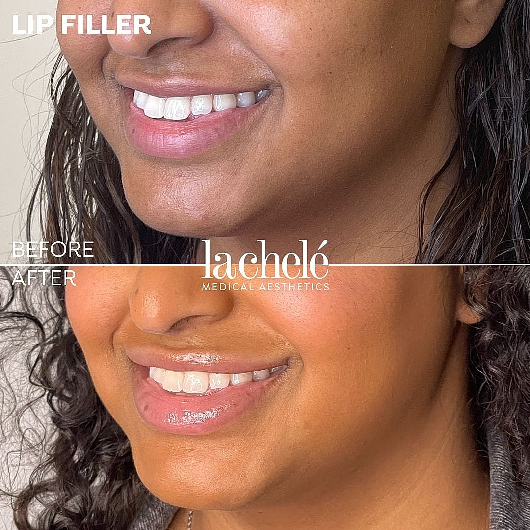 Lip filler before and after results comparison.