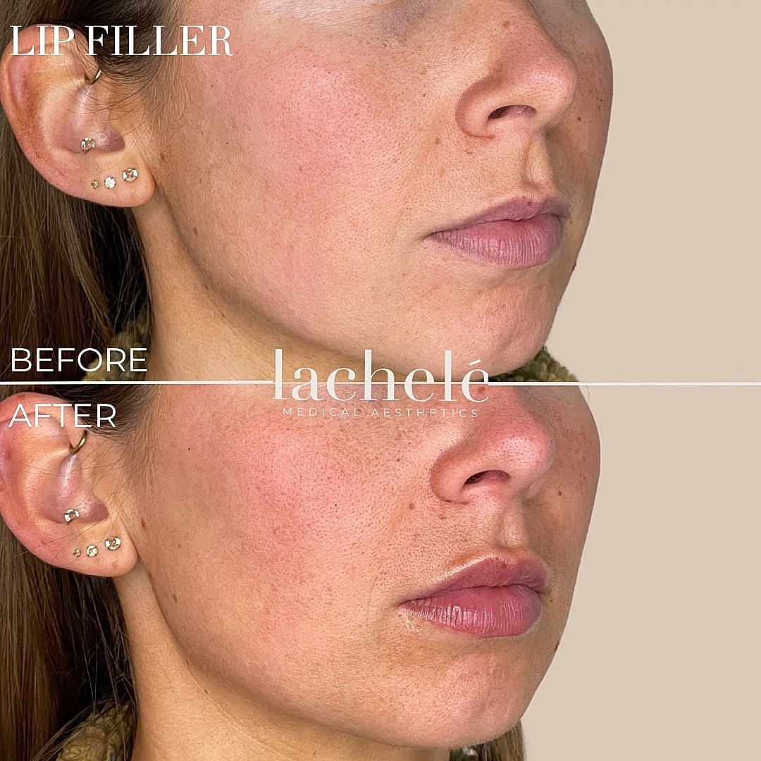 Lip filler before and after transformation image.