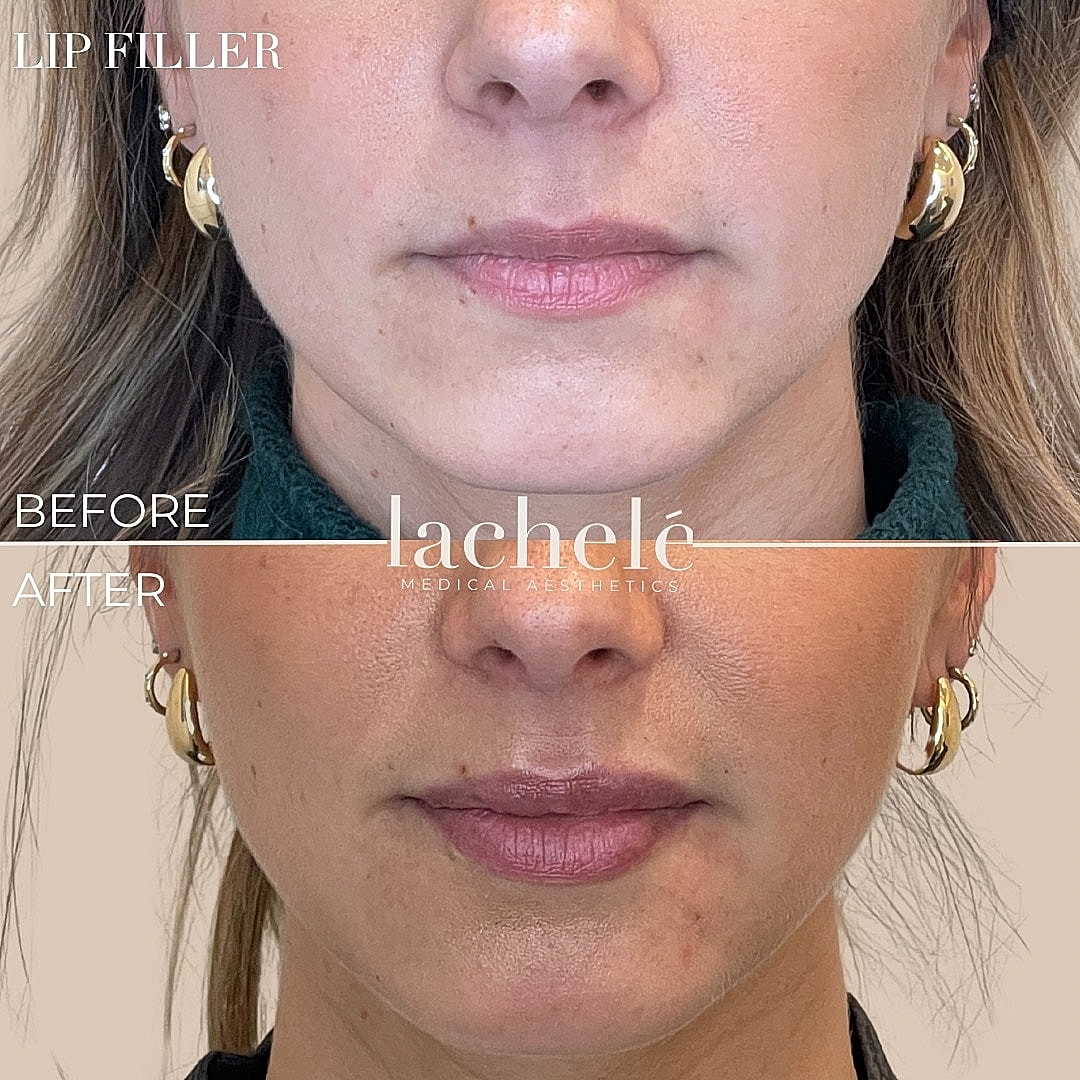 Lip filler results: before and after comparison.