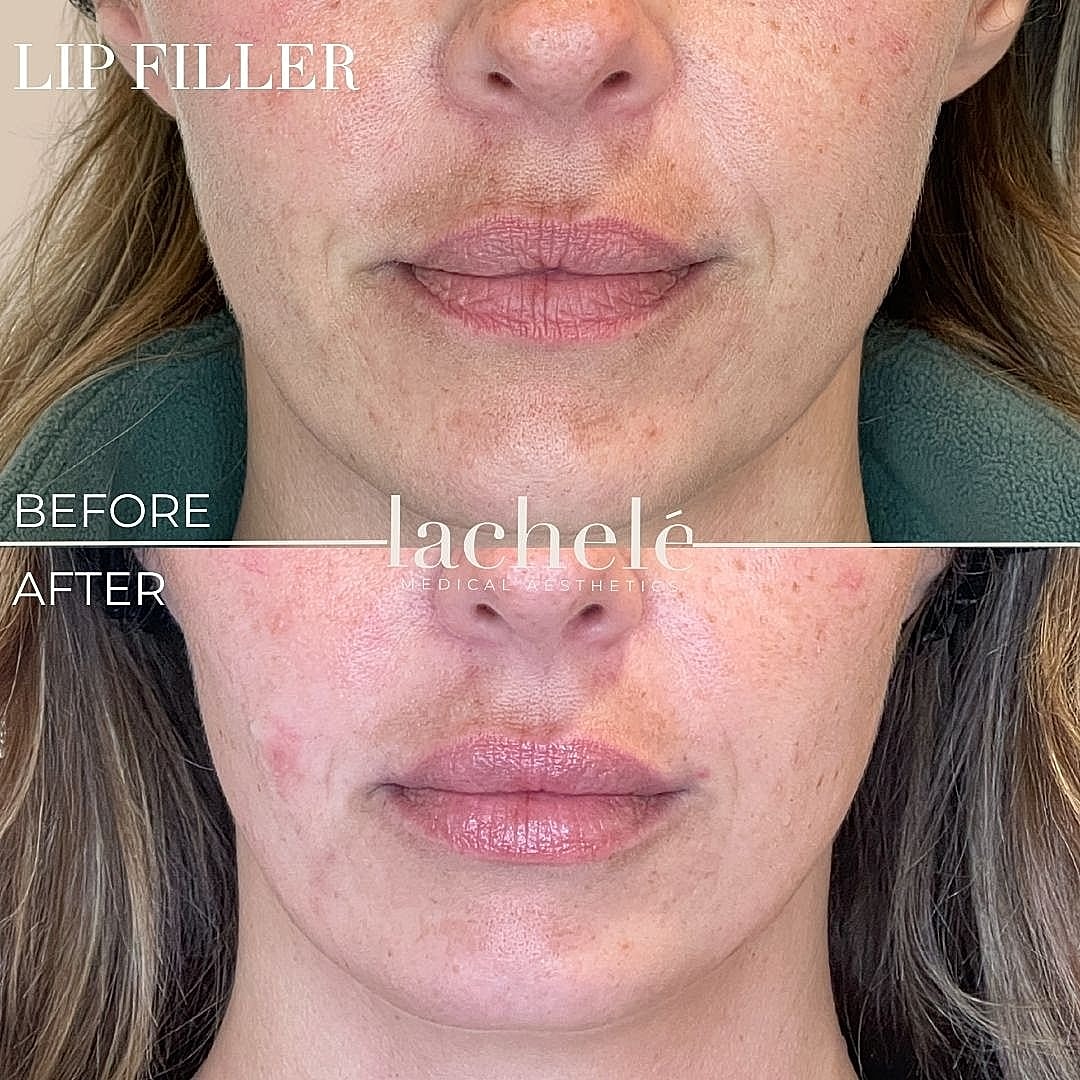 Lip filler before and after transformation.