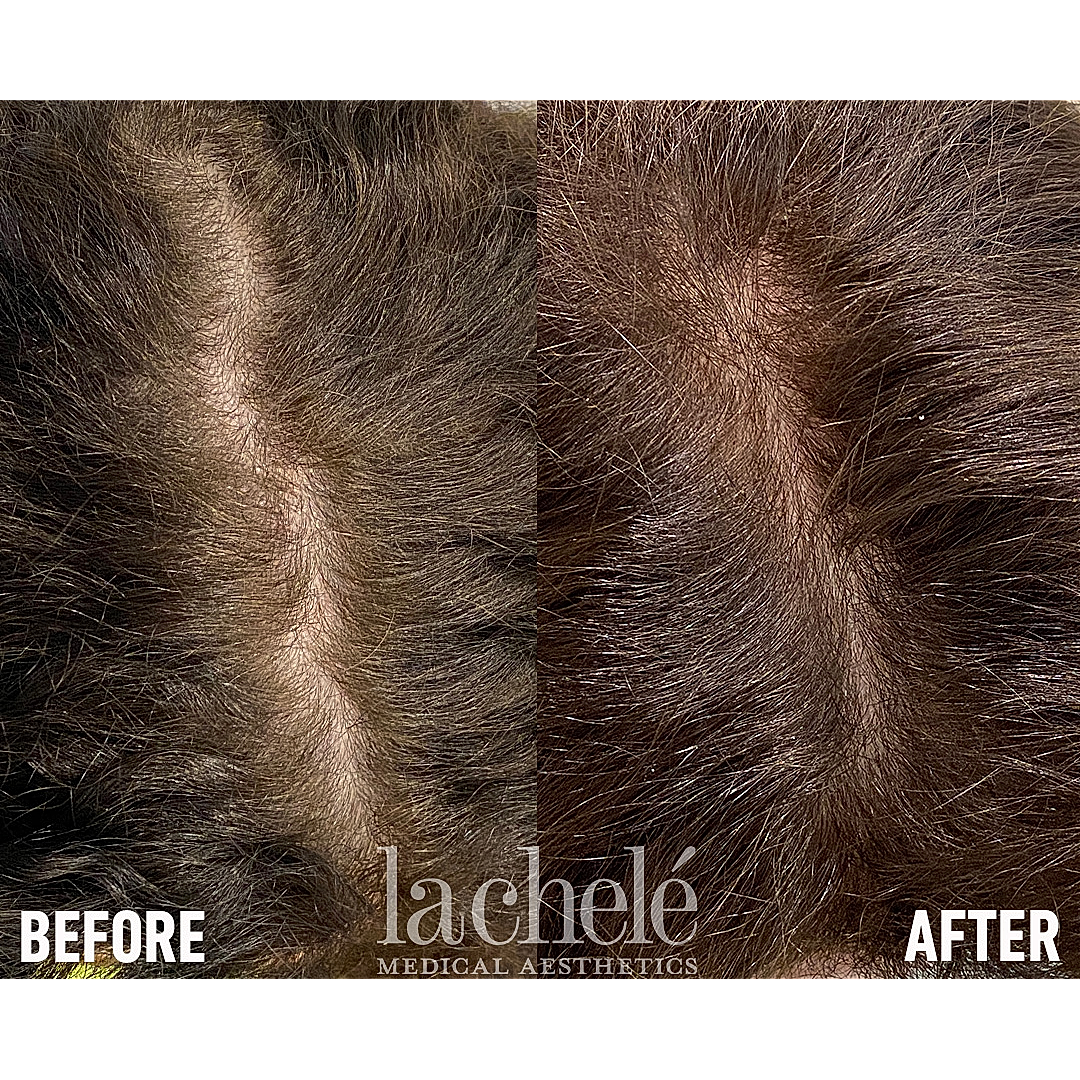 Hair restoration treatment before and after comparison.