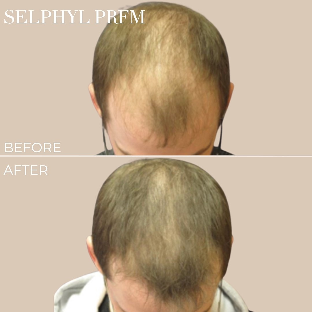 Hair restoration before and after treatment.