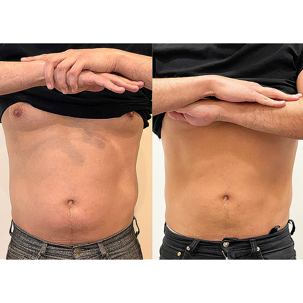 Before and after body transformation comparison.