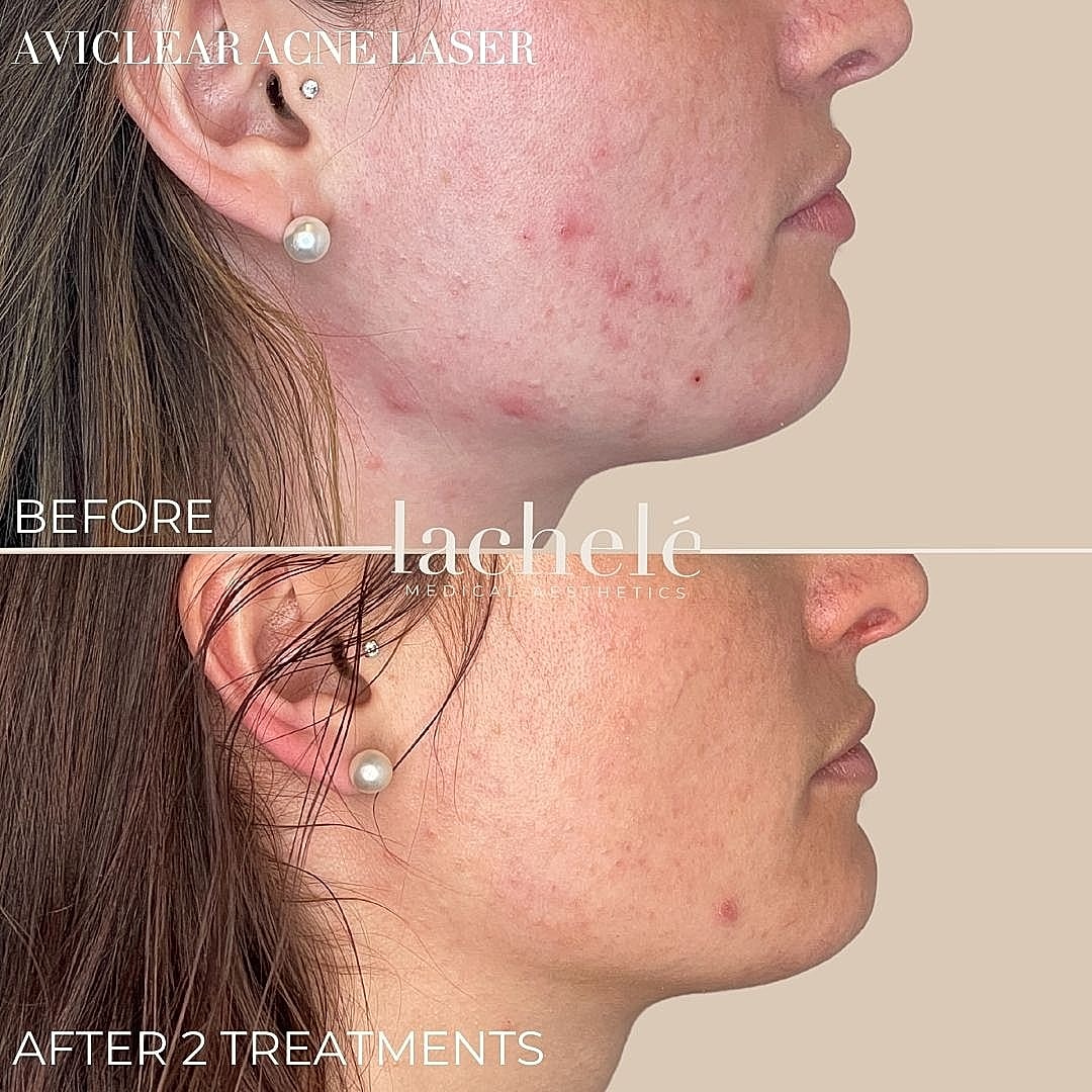 Before and after Aviclear acne laser treatment.
