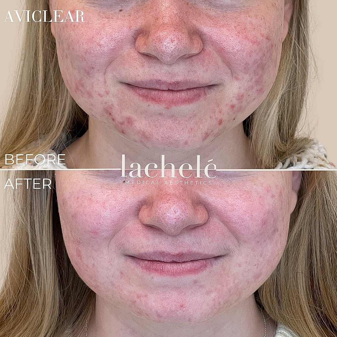 Acne treatment before and after results comparison.
