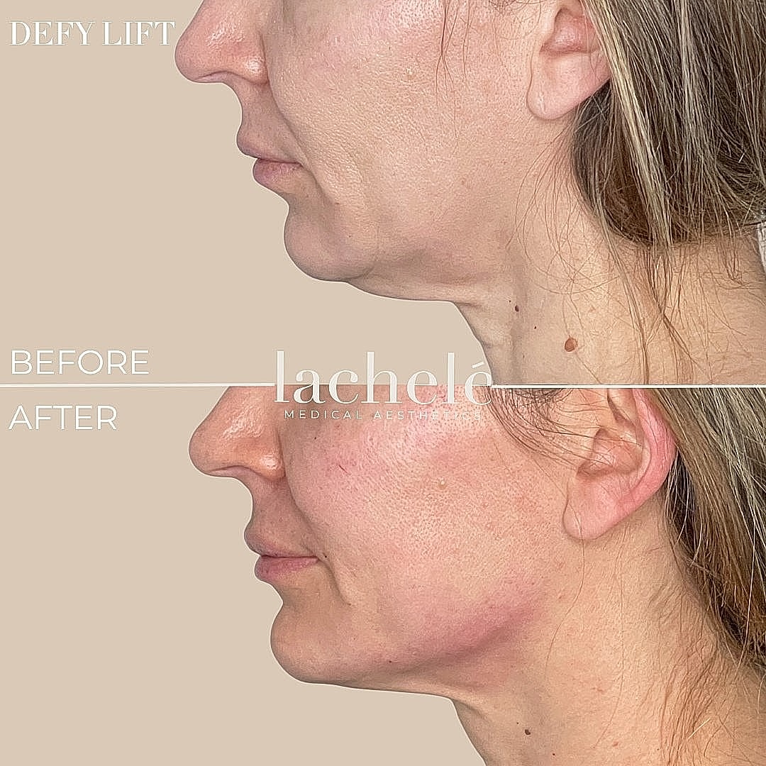Before and after skin lifting treatment comparison