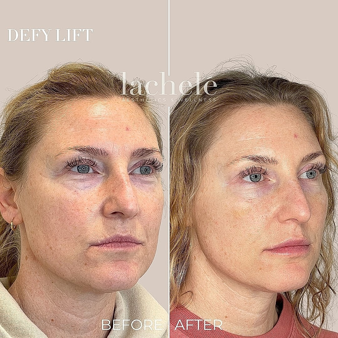 Before and after facial aesthetic treatment results.