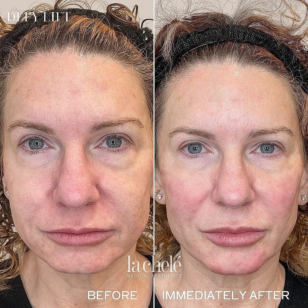 Before and after cosmetic treatment comparison.
