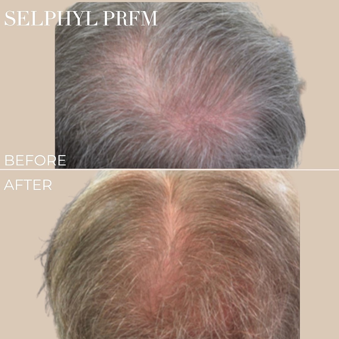 Hair restoration before and after treatment comparison.