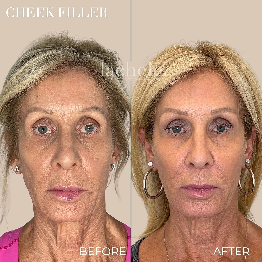 Cheek filler treatment before and after comparison.