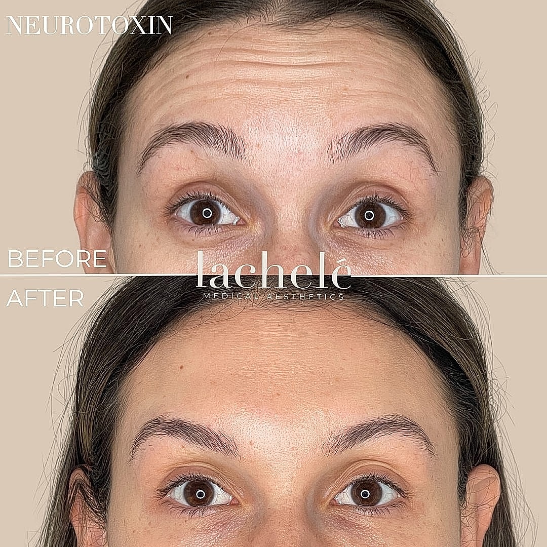 Before and after neurotoxin treatment results.