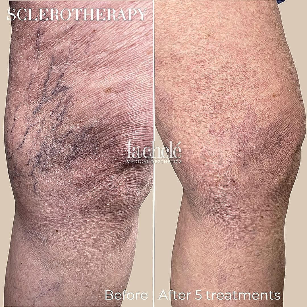 Sclerotherapy results: before and after treatment.