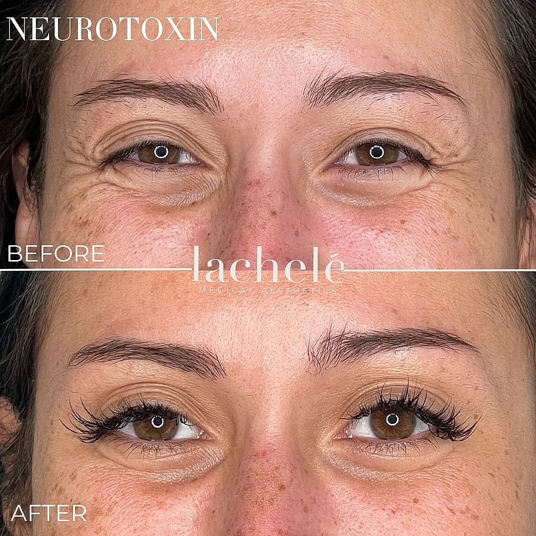 Before and after neurotoxin treatment results.