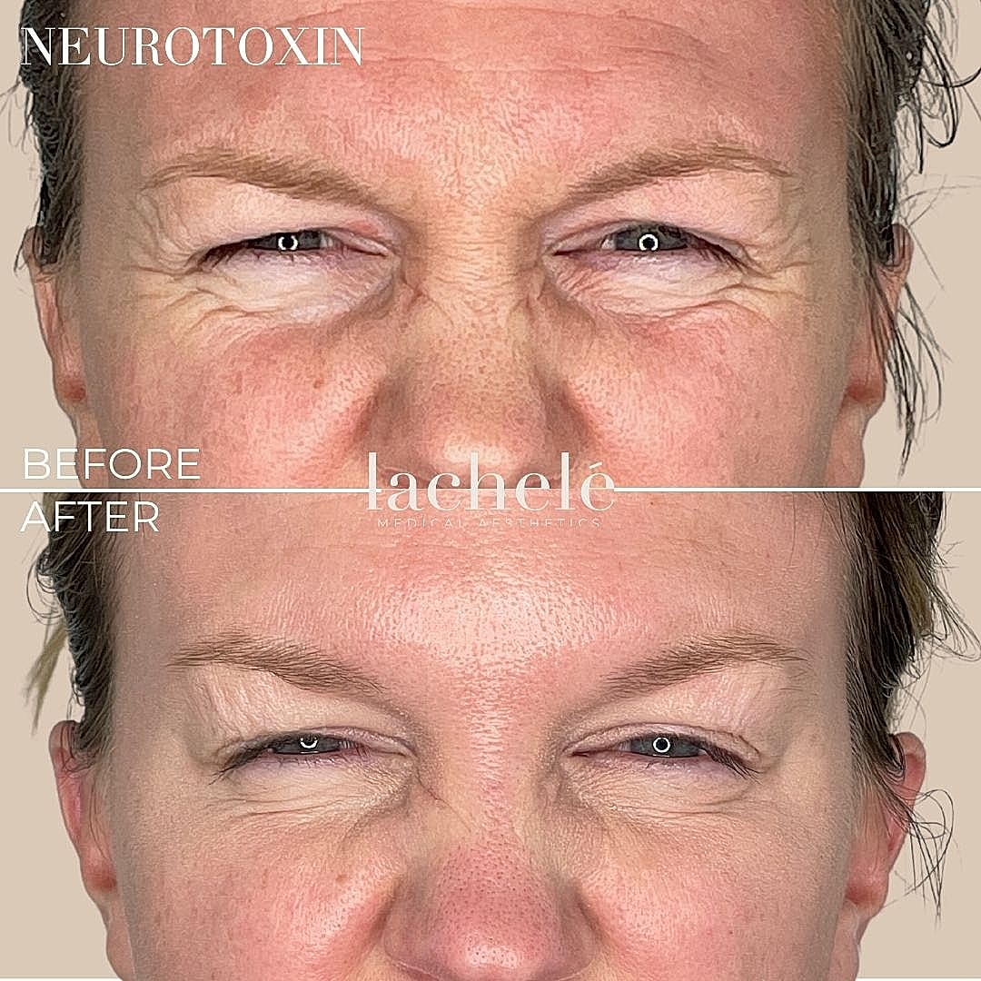 Before and after neurotoxin treatment results