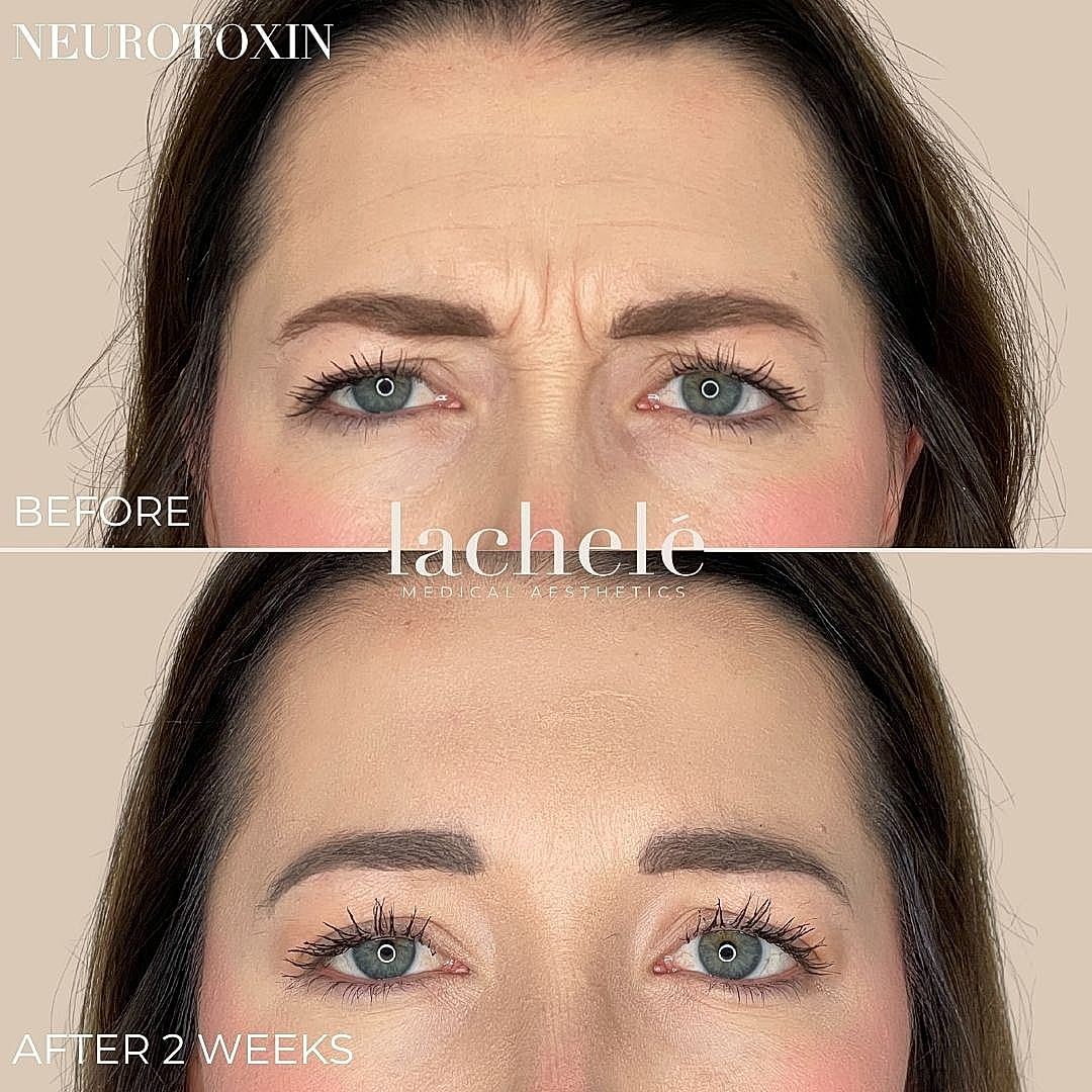 Before and after neurotoxin treatment results.