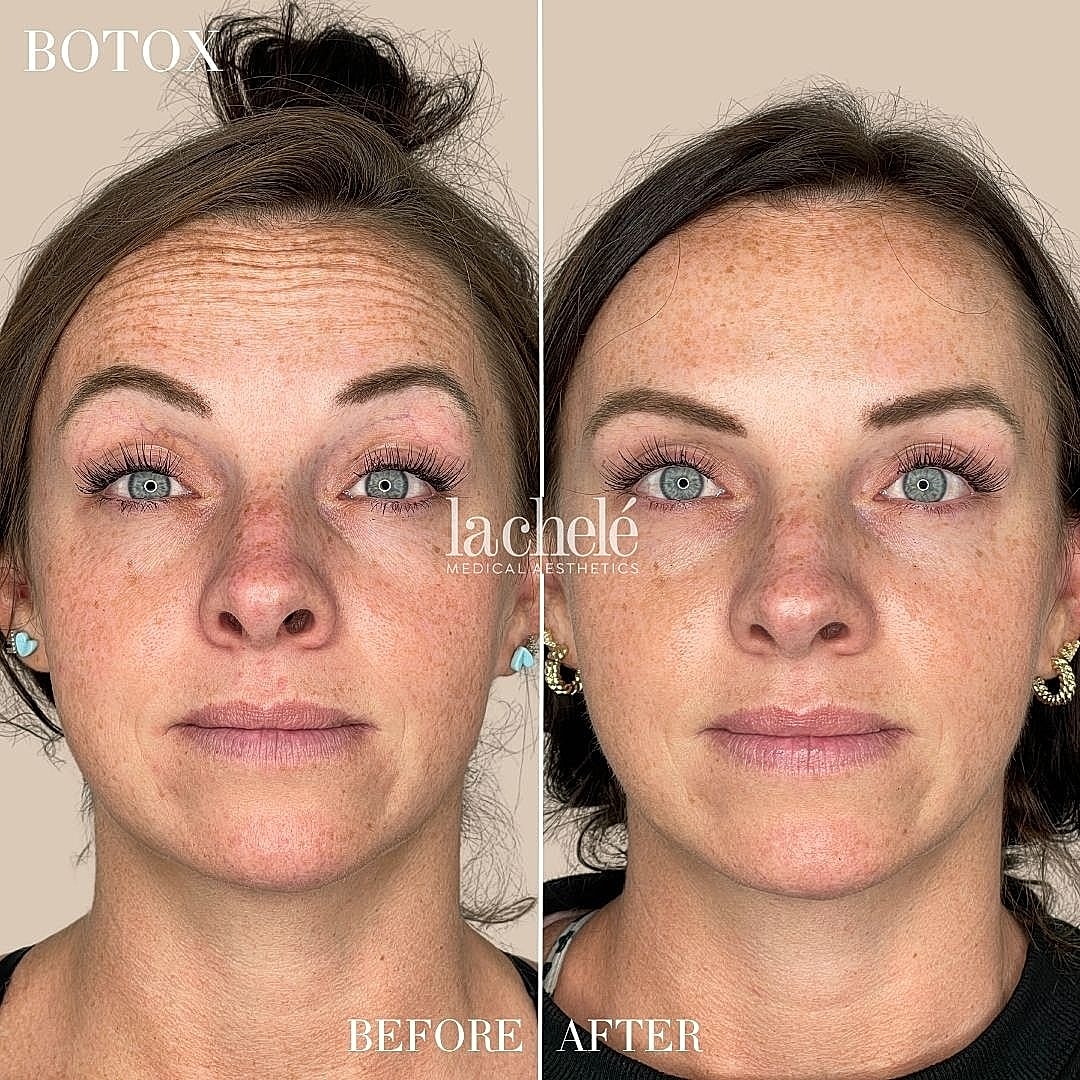 Botox treatment before and after comparison.