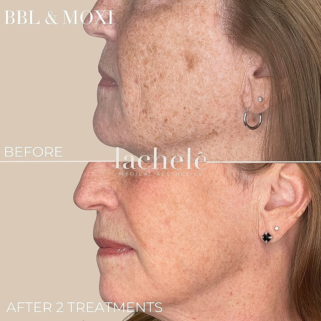 Before and after aesthetic treatment comparison.