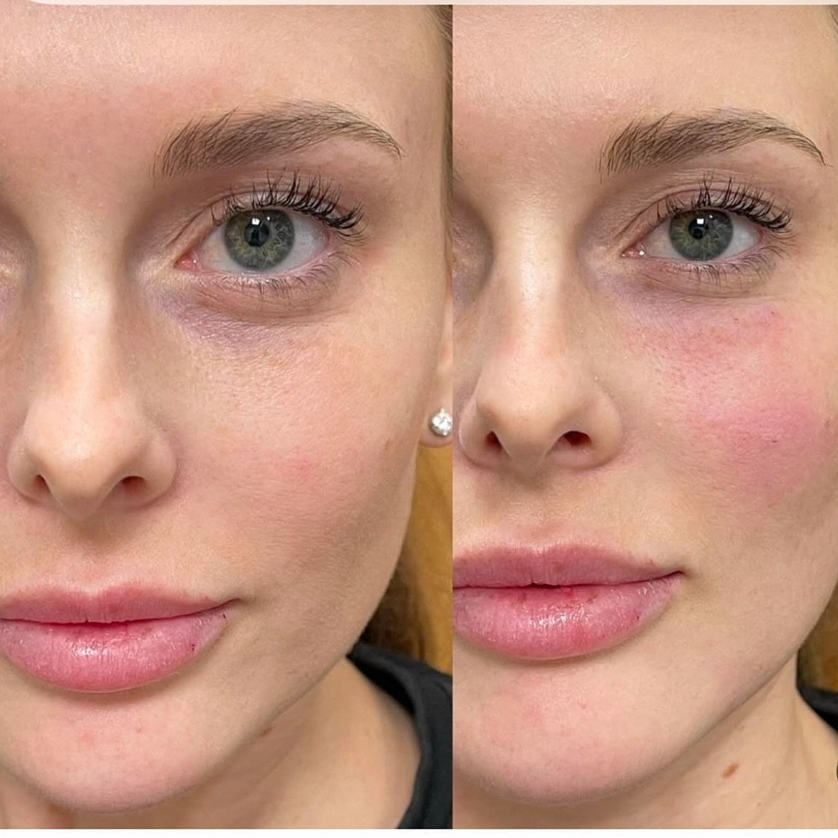 Before and after skin treatment results comparison.