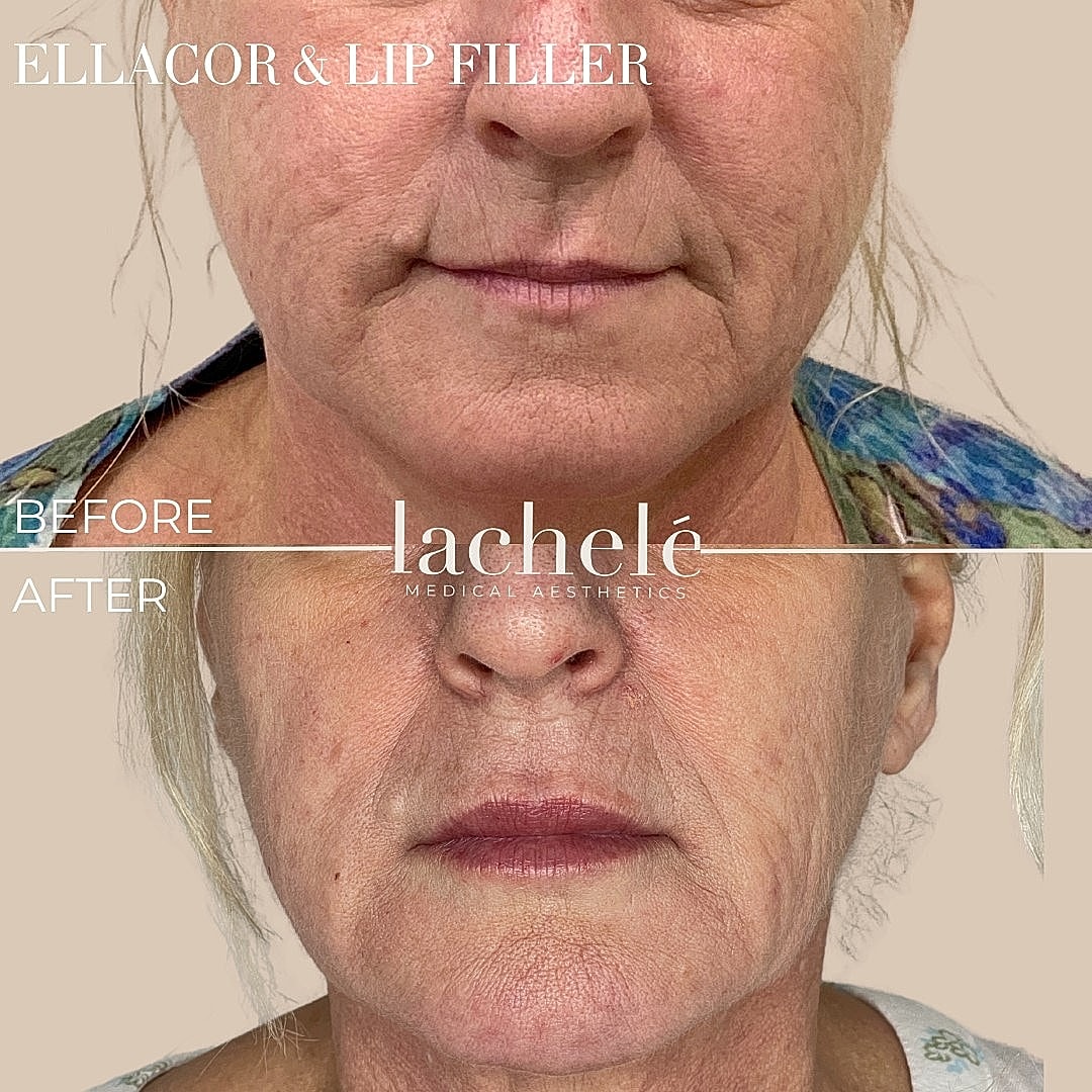 Before and after lip filler treatment comparison