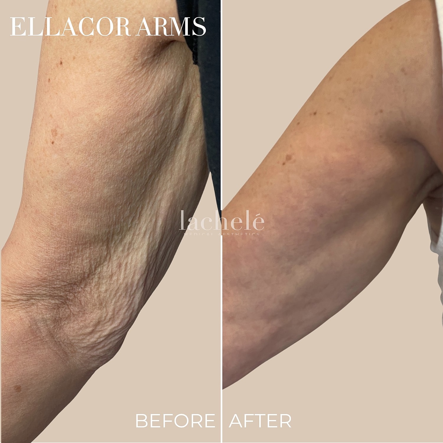 Ellacor Micro-Coring Before & After