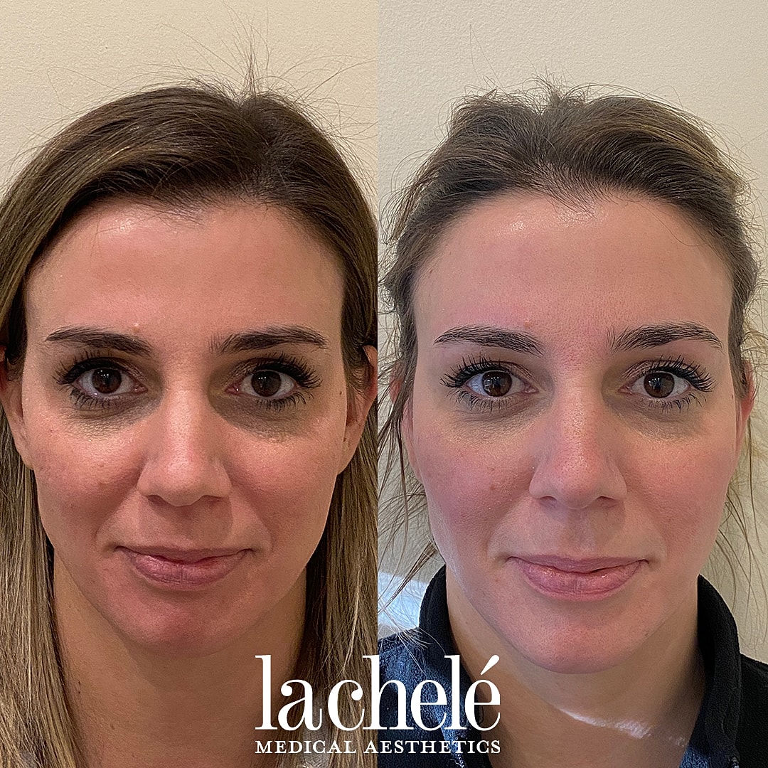 Before and after aesthetic treatment comparison.