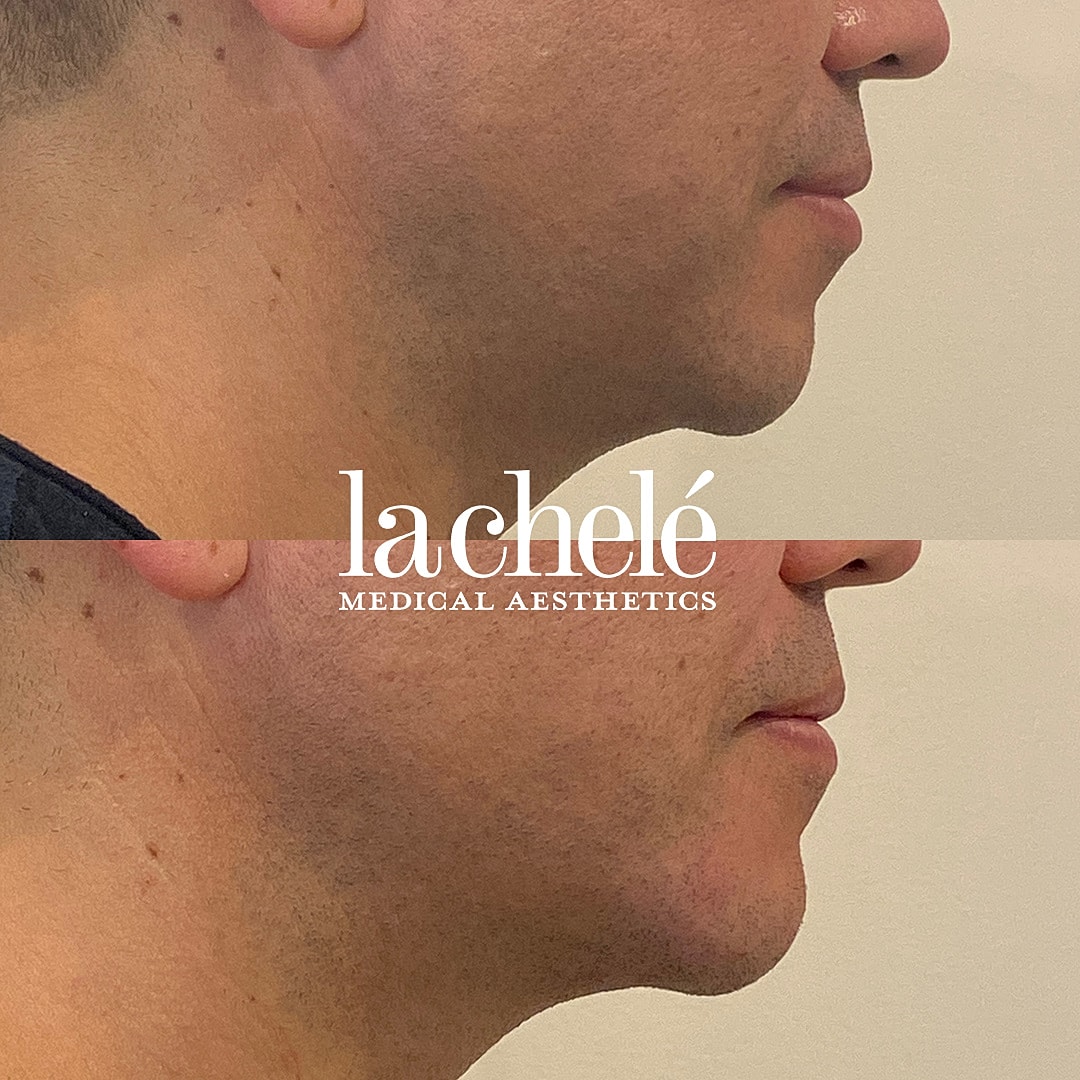 Before and after facial aesthetic treatment comparison.