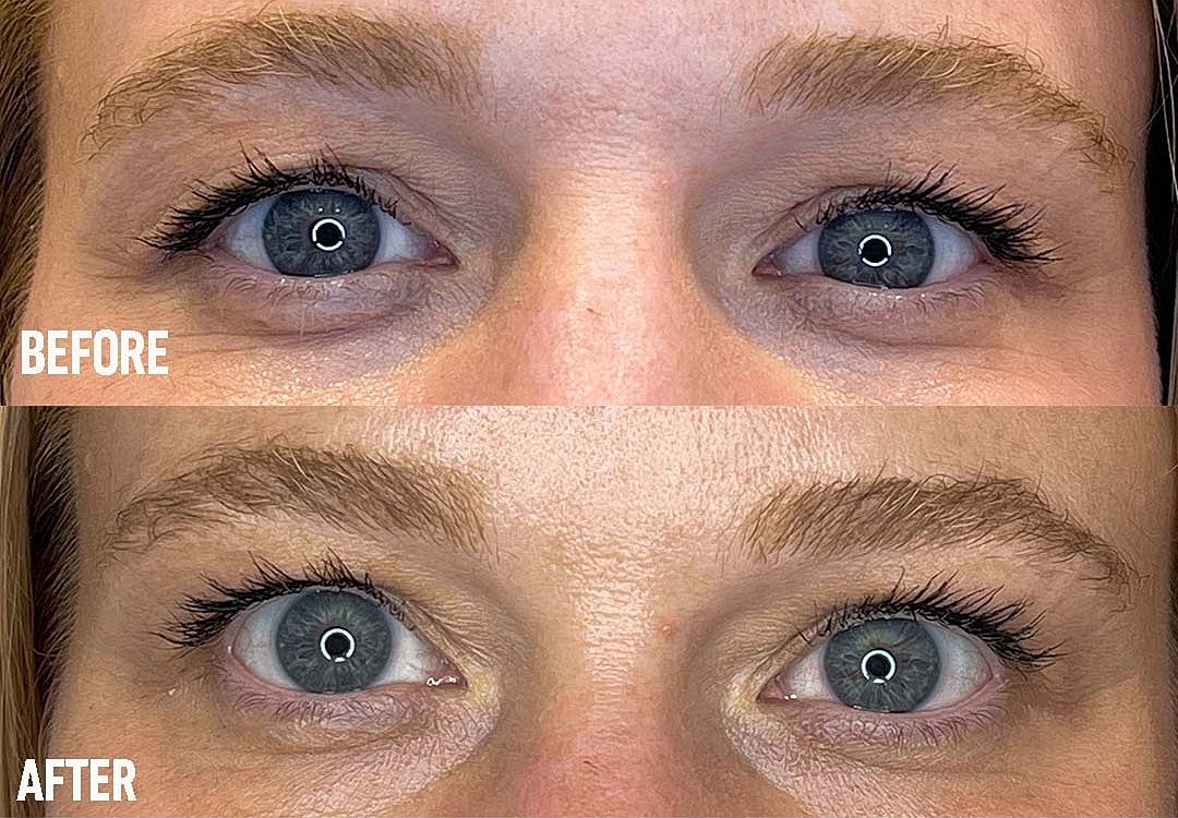 Comparison of eye appearance before and after.