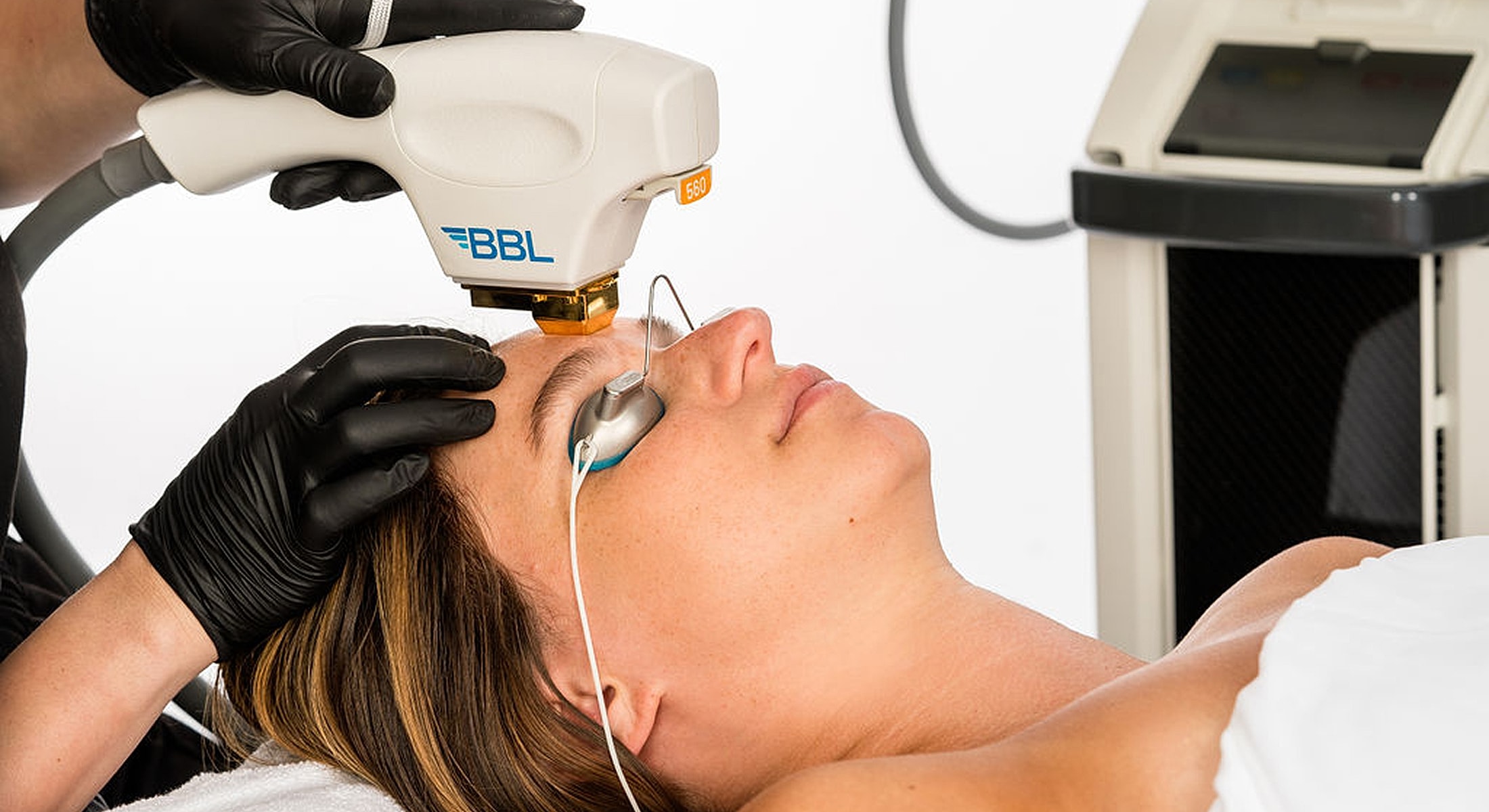 Skin treatment using BBL laser technology.