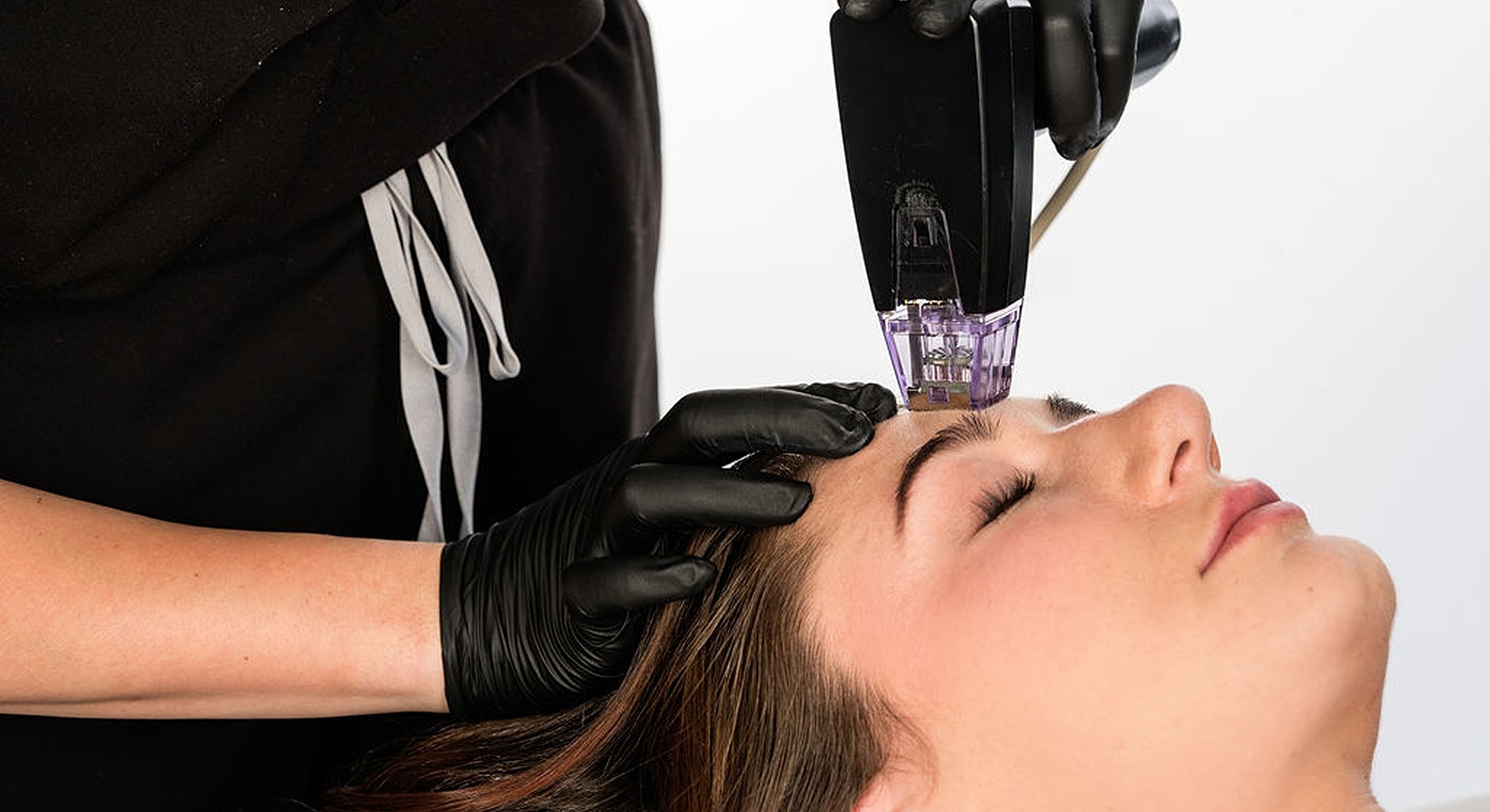Microdermabrasion treatment on a woman's forehead.