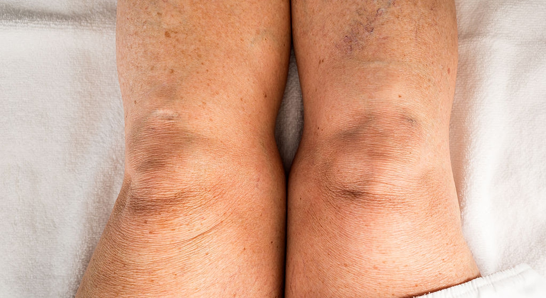 Close-up of human knees on a blanket.