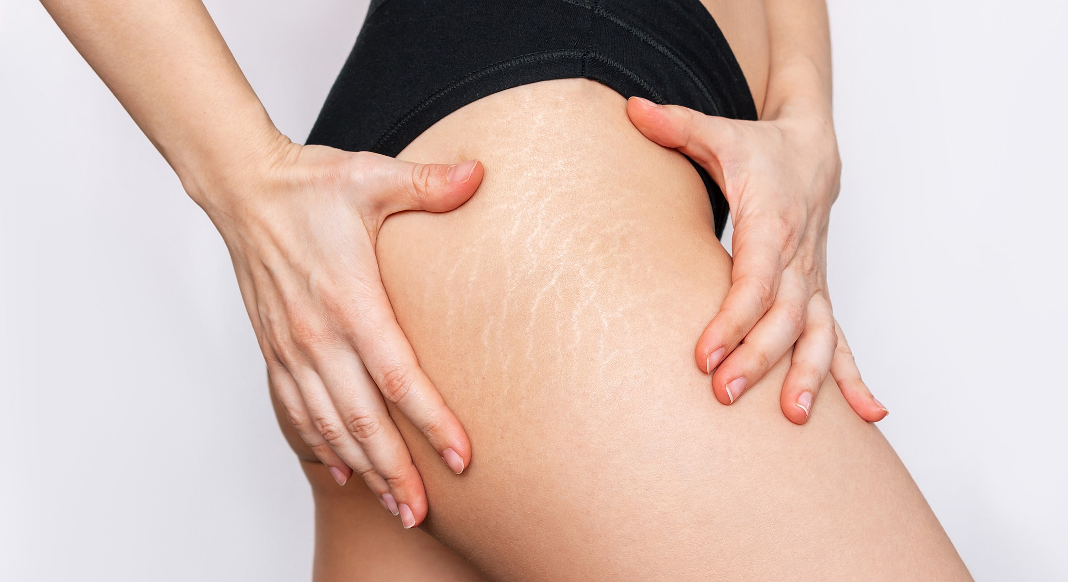 Woman's thigh showing stretch marks and hands.